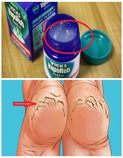 She rubbed her feet with Vicks Vaporub every night. The result will impress you